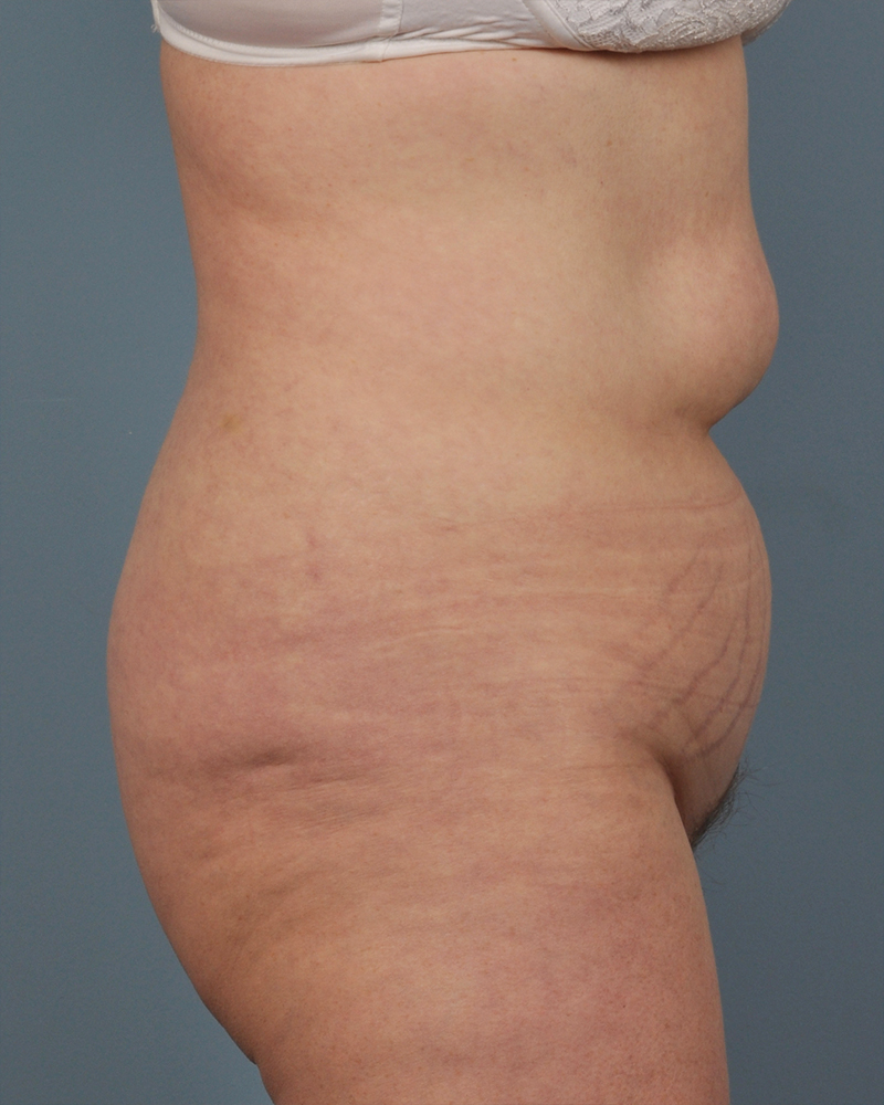 Tummy Tuck Before and After | Dr. Thomas Hubbard