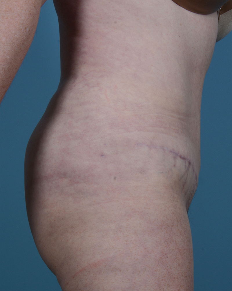 Tummy Tuck Before and After | Dr. Thomas Hubbard