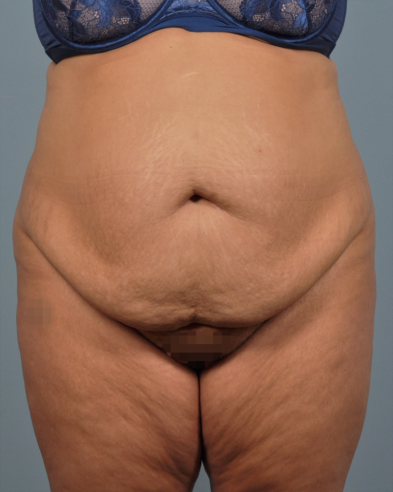 Tummy Tuck Before and After | Dr. Thomas Hubbard