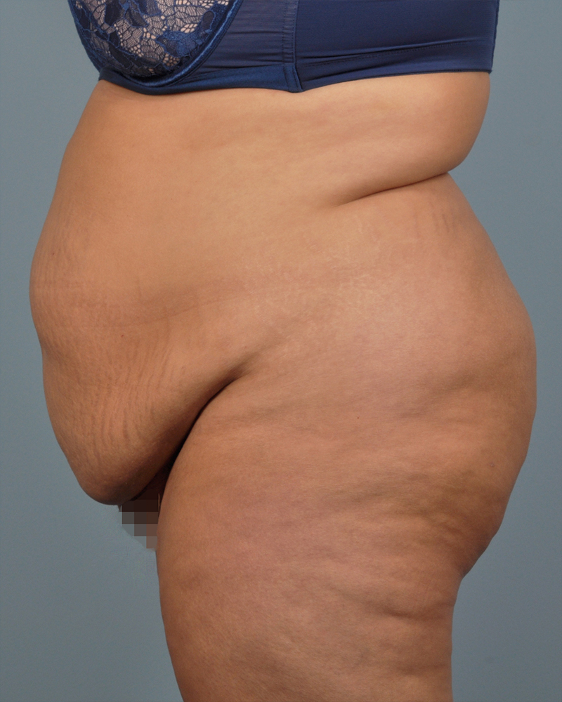 Tummy Tuck Before and After | Dr. Thomas Hubbard