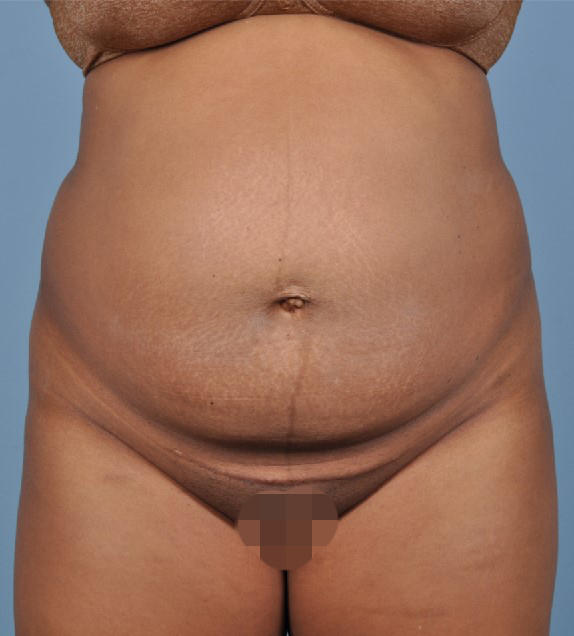 Tummy Tuck Before and After | Dr. Thomas Hubbard