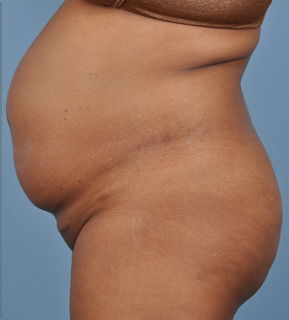 Tummy Tuck Before and After | Dr. Thomas Hubbard