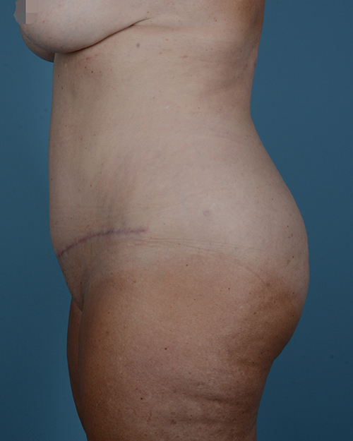 Tummy Tuck Before and After | Dr. Thomas Hubbard