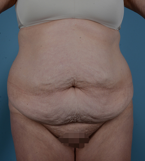 Tummy Tuck Before and After | Dr. Thomas Hubbard