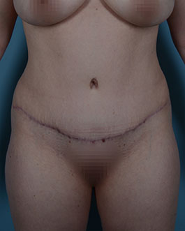 Tummy Tuck Before and After | Dr. Thomas Hubbard