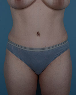 Tummy Tuck Before and After | Dr. Thomas Hubbard