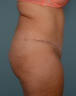 Tummy Tuck Before and After | Dr. Thomas Hubbard