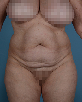 Tummy Tuck Before and After | Dr. Thomas Hubbard