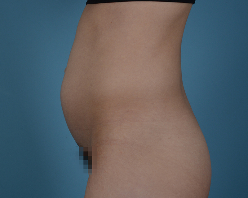 Tummy Tuck Before and After | Dr. Thomas Hubbard