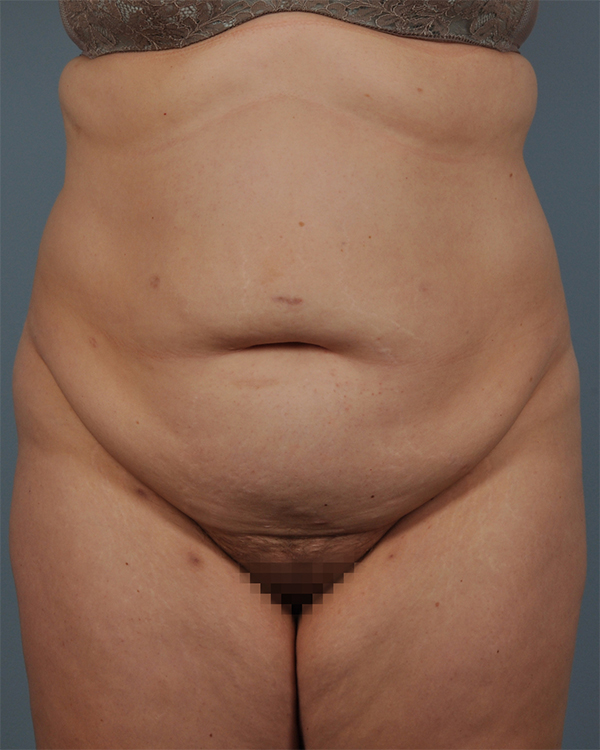 Tummy Tuck Before and After | Dr. Thomas Hubbard