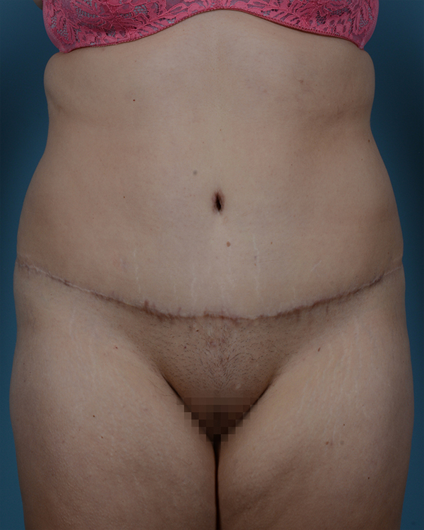 Tummy Tuck Before and After | Dr. Thomas Hubbard