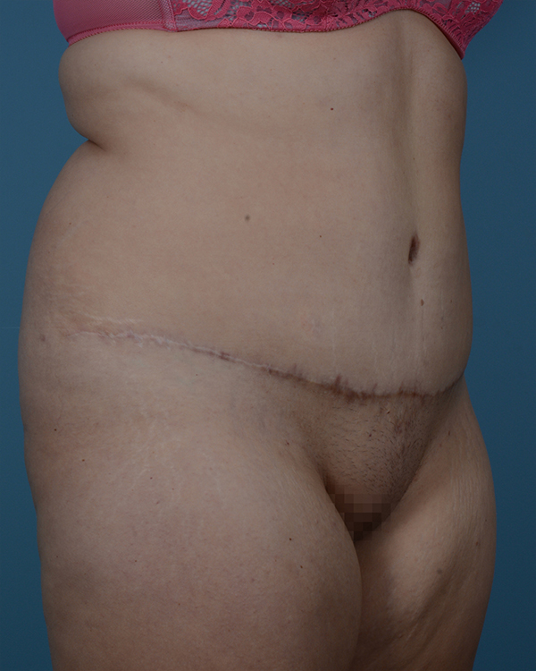 Tummy Tuck Before and After | Dr. Thomas Hubbard