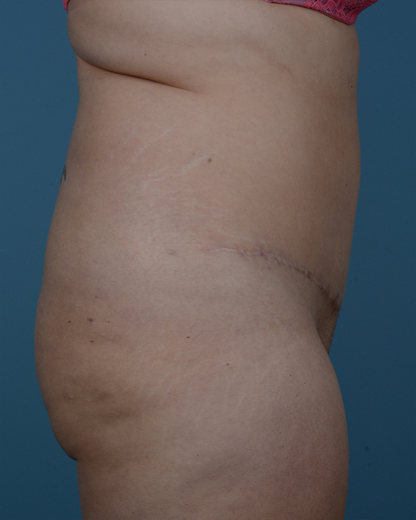 Tummy Tuck Before and After | Dr. Thomas Hubbard