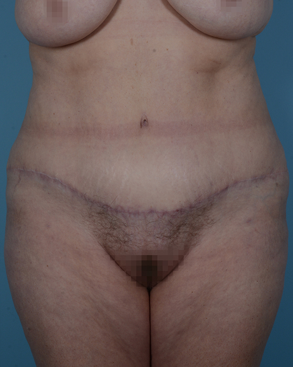 Tummy Tuck Before and After | Dr. Thomas Hubbard