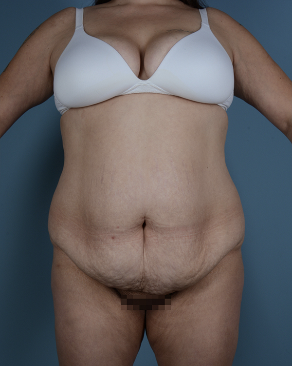 Tummy Tuck Before and After | Dr. Thomas Hubbard