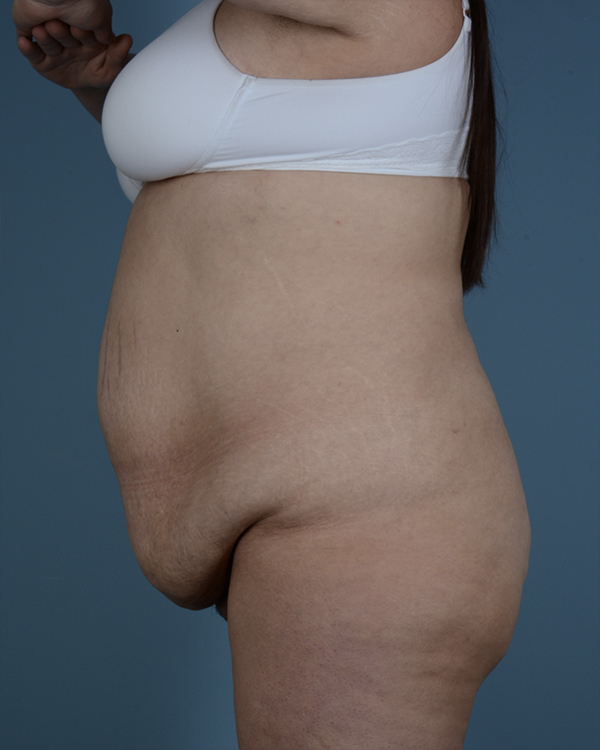 Tummy Tuck Before and After | Dr. Thomas Hubbard