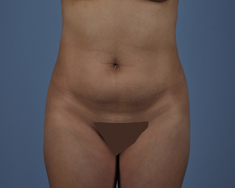 Tummy Tuck Before and After | Dr. Thomas Hubbard