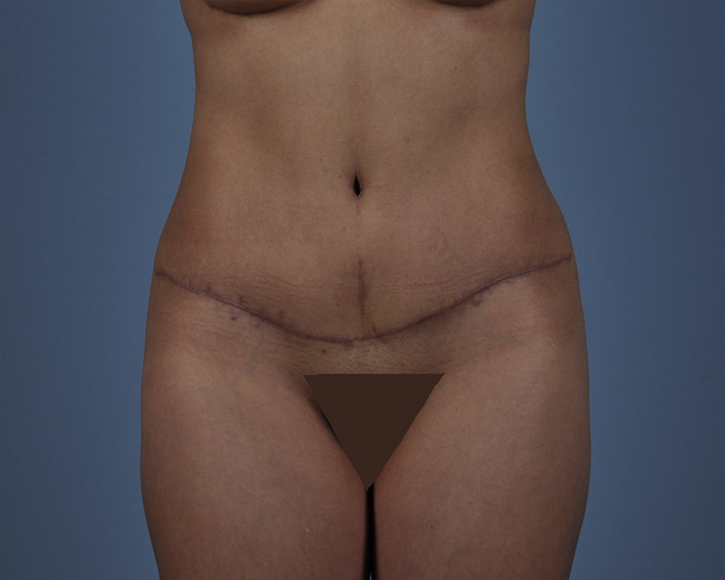 Tummy Tuck Before and After | Dr. Thomas Hubbard