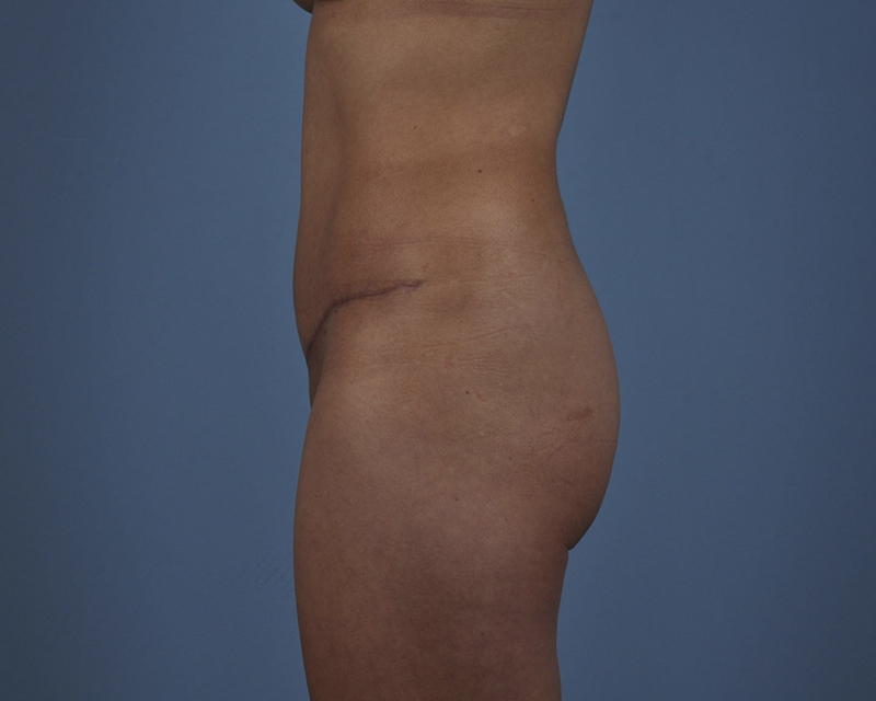 Tummy Tuck Before and After | Dr. Thomas Hubbard