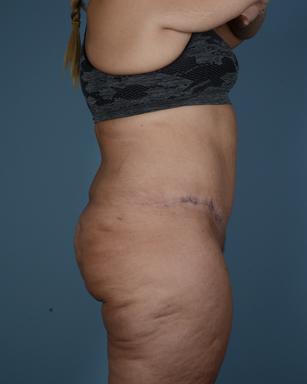 Tummy Tuck Before and After | Dr. Thomas Hubbard