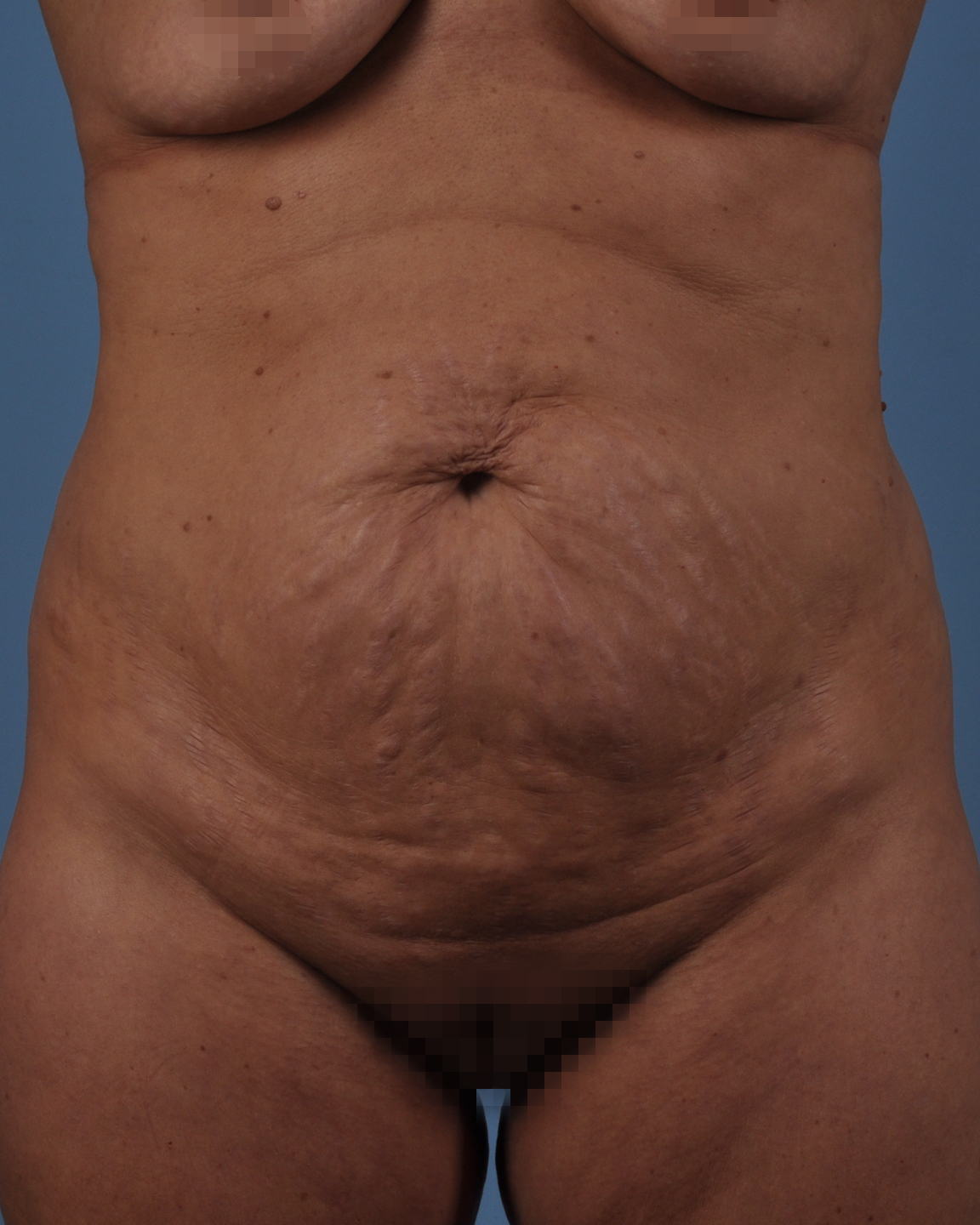 Tummy Tuck Before and After | Dr. Thomas Hubbard