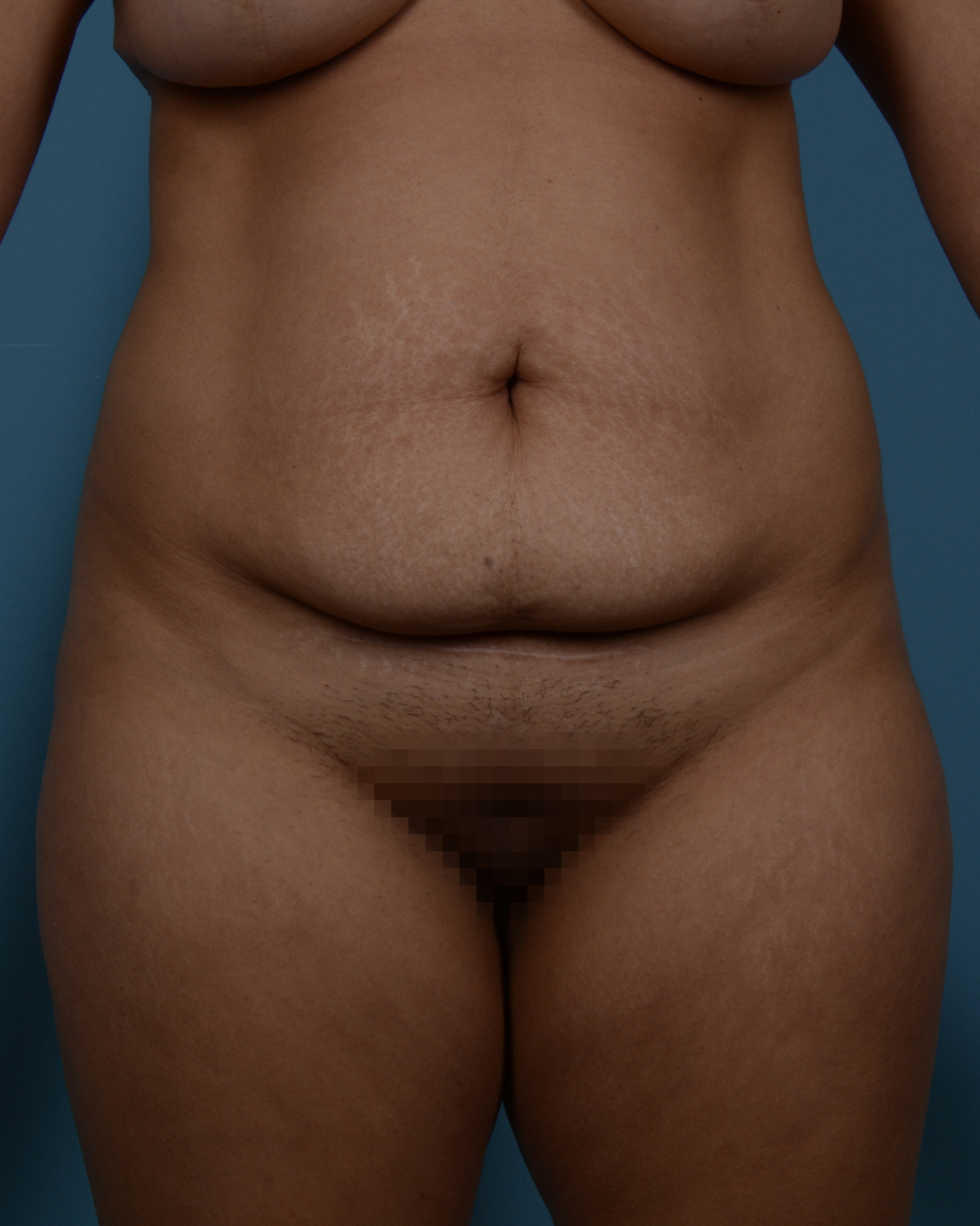 Tummy Tuck Before and After | Dr. Thomas Hubbard