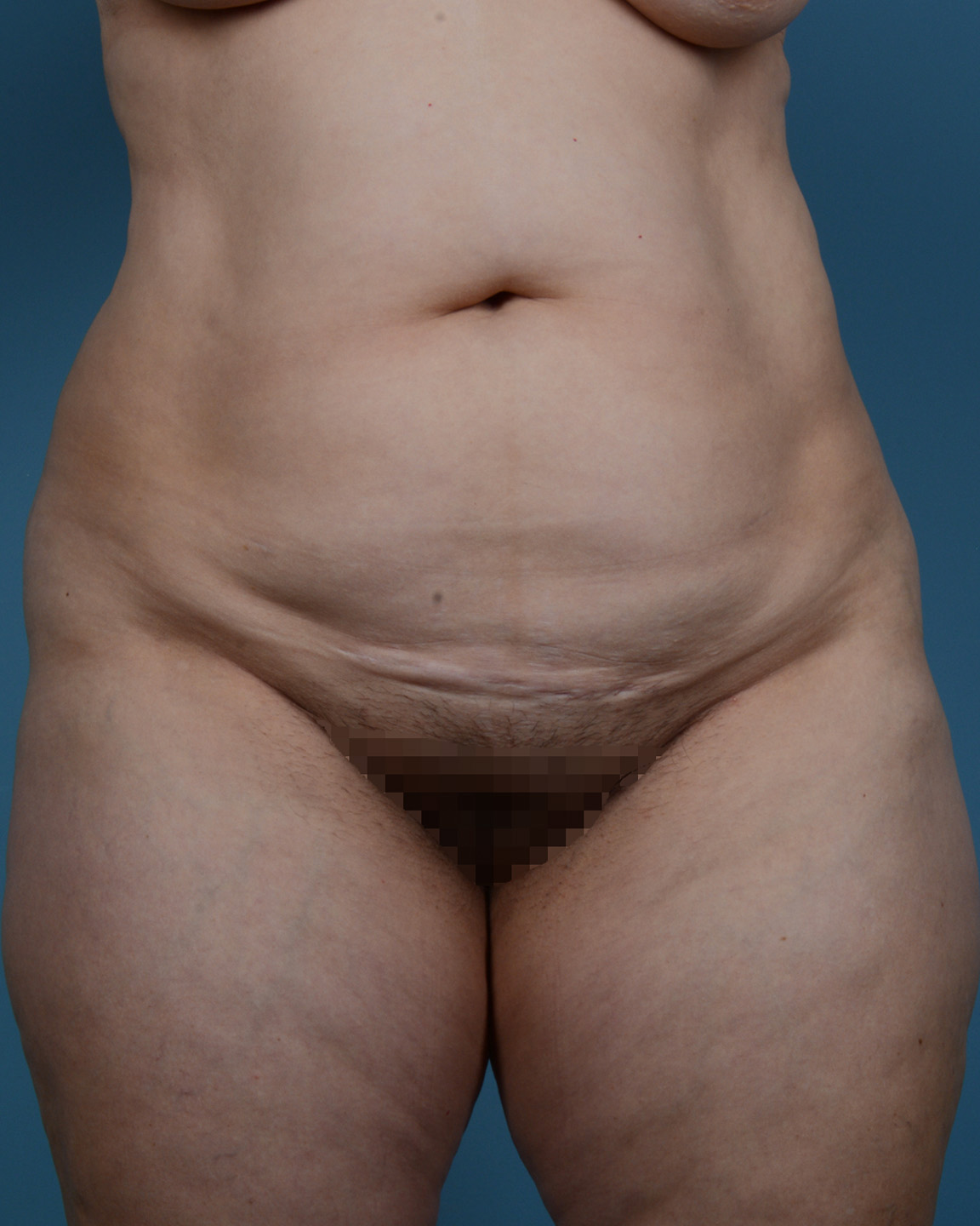 Tummy Tuck Before and After | Dr. Thomas Hubbard