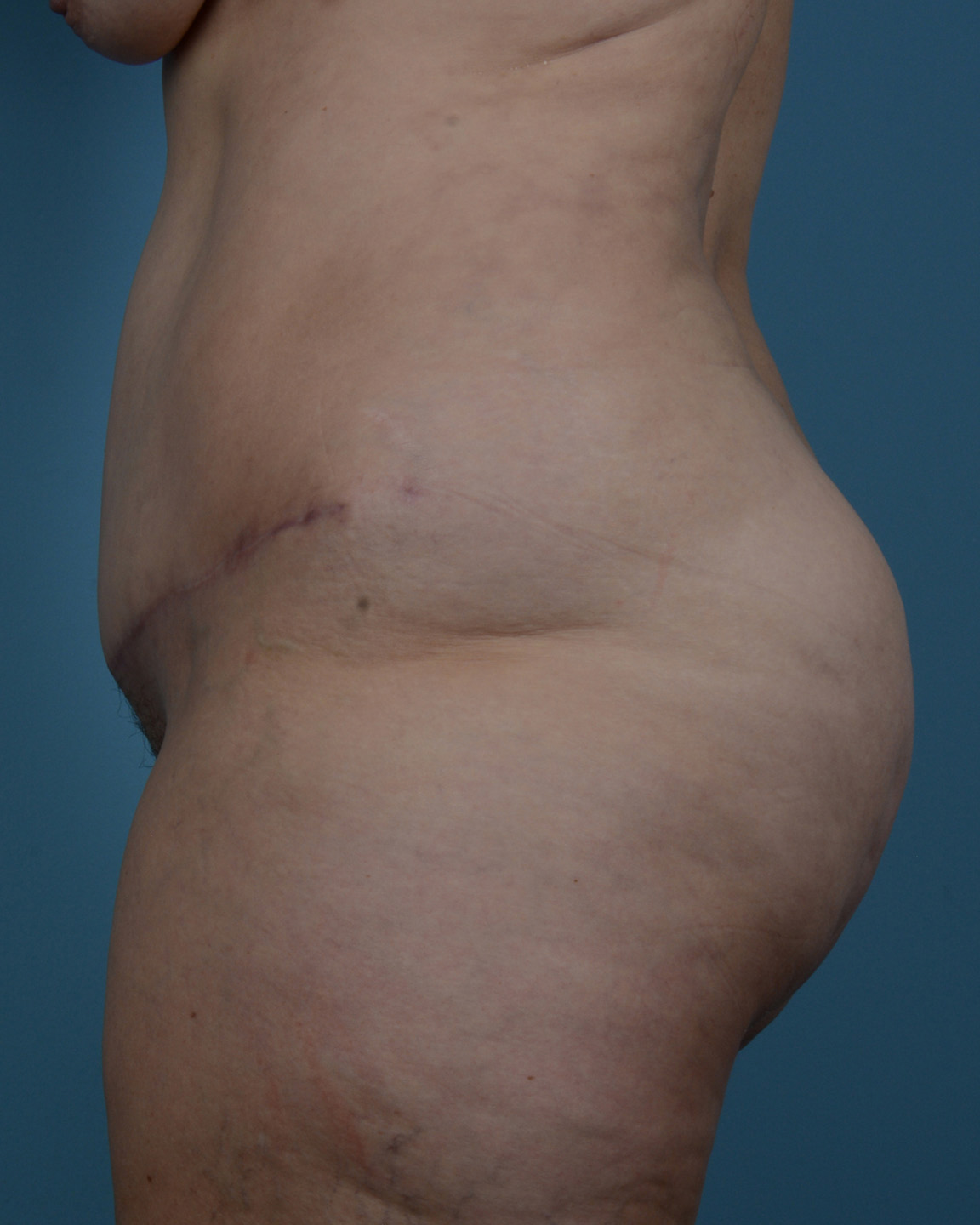 Tummy Tuck Before and After | Dr. Thomas Hubbard