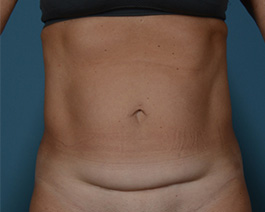 Tummy Tuck Before and After | Dr. Thomas Hubbard