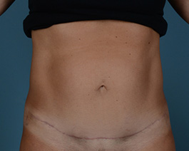 Tummy Tuck Before and After | Dr. Thomas Hubbard