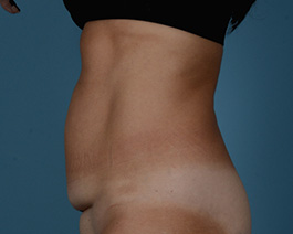 Tummy Tuck Before and After | Dr. Thomas Hubbard