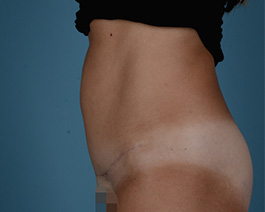 Tummy Tuck Before and After | Dr. Thomas Hubbard