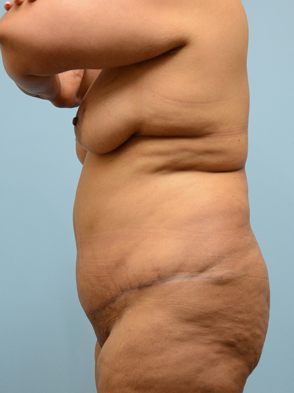 Tummy Tuck Before and After | Dr. Thomas Hubbard