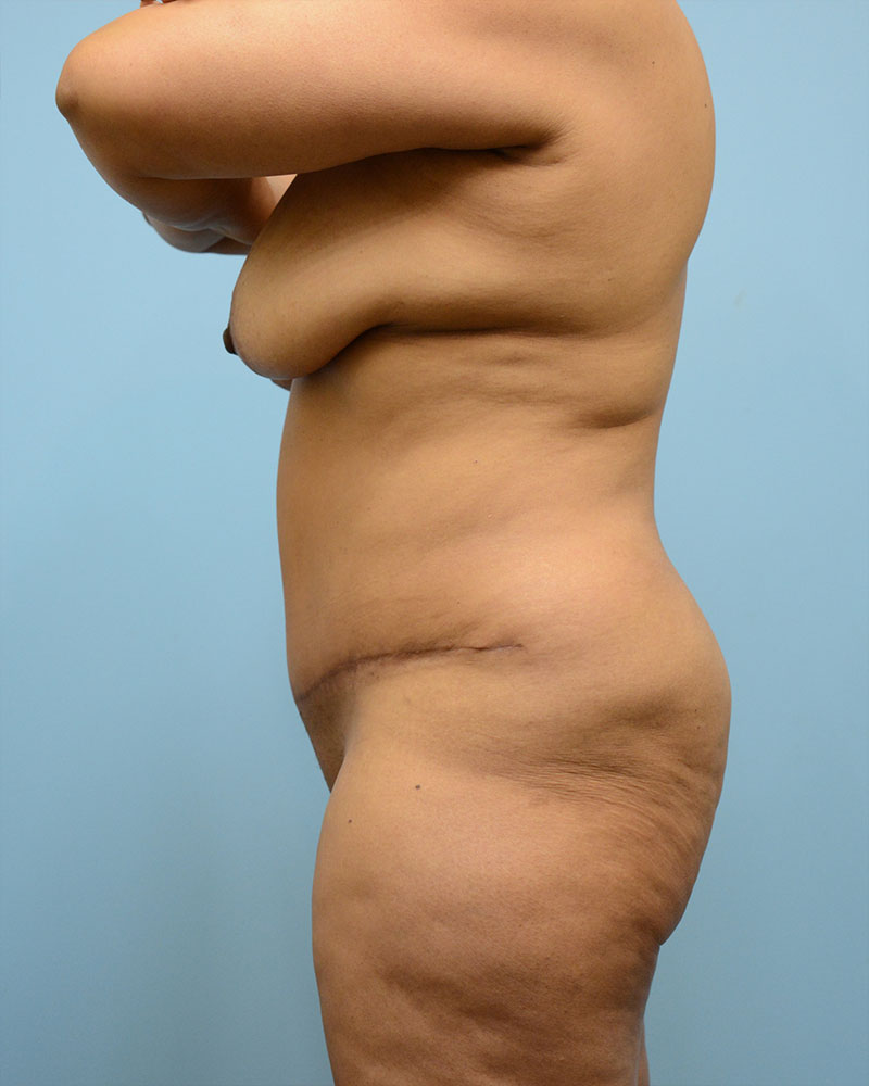 Tummy Tuck Before and After | Dr. Thomas Hubbard