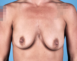 Breast Augmentation With Lift Before and After | Dr. Thomas Hubbard