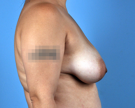 Breast Augmentation With Lift Before and After | Dr. Thomas Hubbard