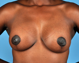 Breast Augmentation With Lift Before and After | Dr. Thomas Hubbard