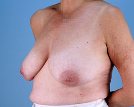 Breast Augmentation With Lift Before and After | Dr. Thomas Hubbard