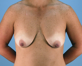 Breast Augmentation With Lift Before and After | Dr. Thomas Hubbard