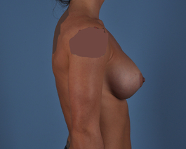 Breast Augmentation With Lift Before and After | Dr. Thomas Hubbard