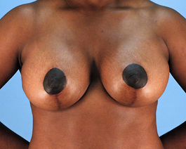 Breast Augmentation With Lift Before and After | Dr. Thomas Hubbard