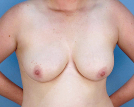 Breast Augmentation With Lift Before and After | Dr. Thomas Hubbard