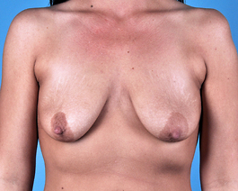 Breast Augmentation With Lift Before and After | Dr. Thomas Hubbard