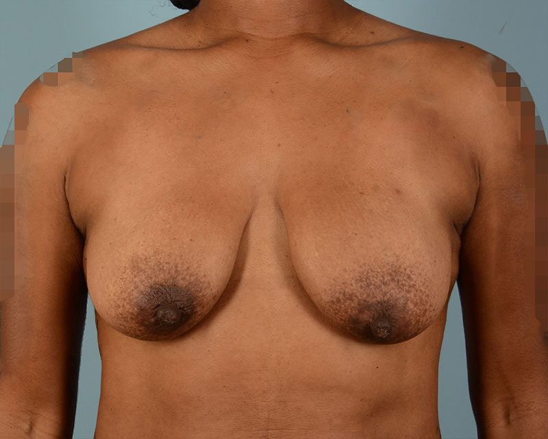 Breast Augmentation With Lift Before and After | Dr. Thomas Hubbard