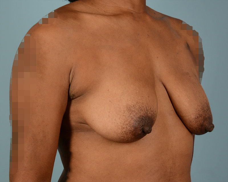 Breast Augmentation With Lift Before and After | Dr. Thomas Hubbard