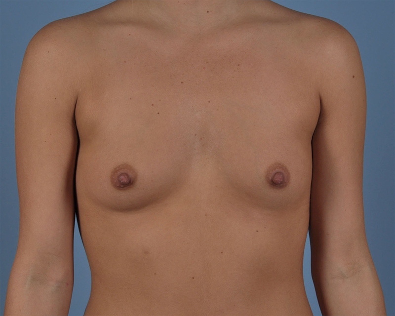 Breast Augmentation Before and After | Dr. Thomas Hubbard