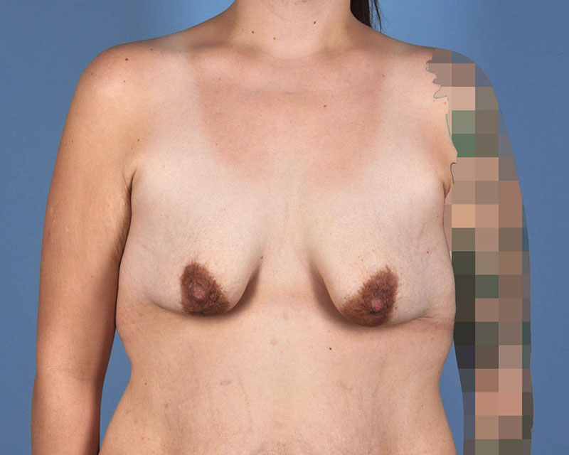 Breast Augmentation Before and After | Dr. Thomas Hubbard