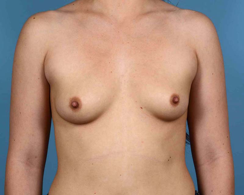 Breast Augmentation Before and After | Dr. Thomas Hubbard