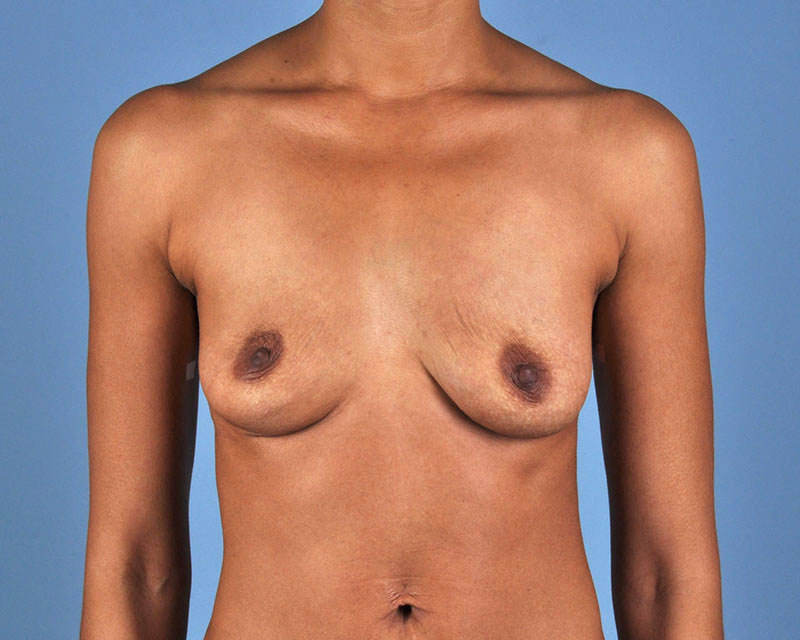 Breast Augmentation Before and After | Dr. Thomas Hubbard