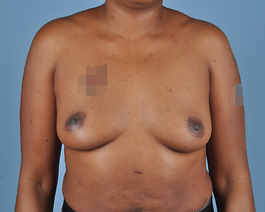 Breast Augmentation Before and After | Dr. Thomas Hubbard